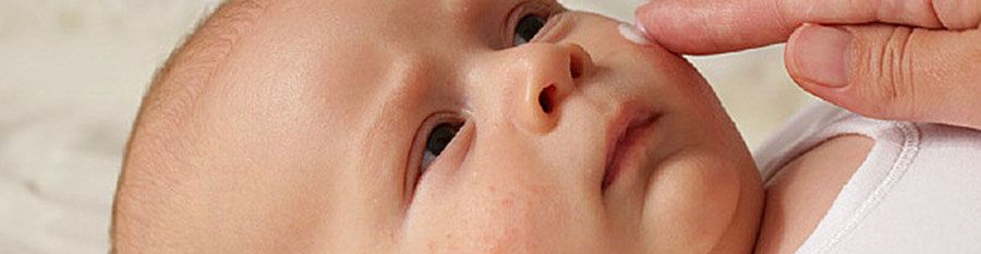حساسیت پوستی نوزاد چیست؟
